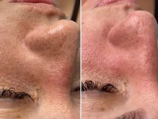 v-carbon-system-before-and-after-image-2