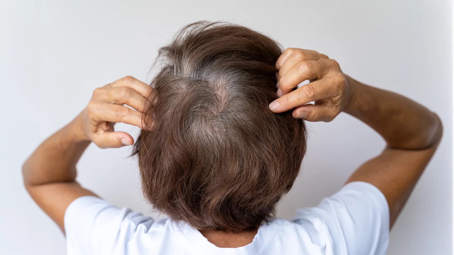 Hair loss treatment for women