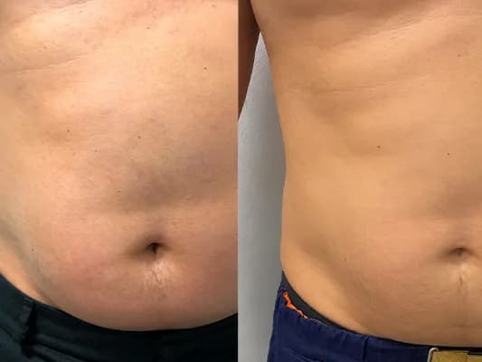 Exo-V-Slim-System-before-and-after-image-2