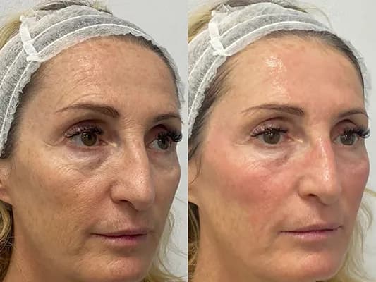 zk-face-before-and-after-image-1