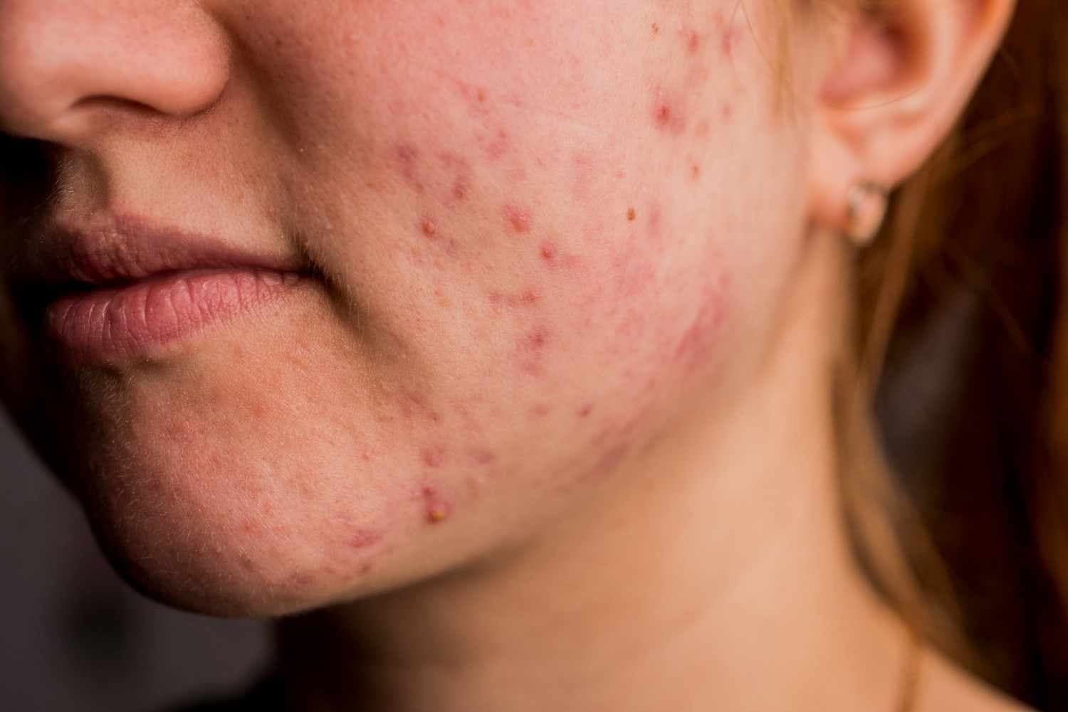 many-pimples-girl